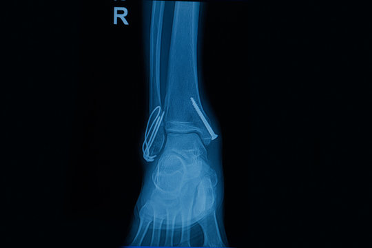 human x-rays  showing fracture of right leg ( fracture both bones )