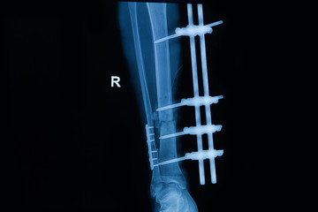  human x-rays , fracture of right leg post operated with external fixation 