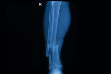 Collection of human x-rays  showing fracture of right leg