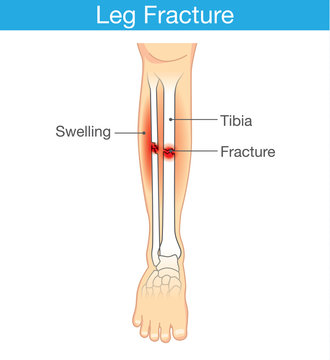 Diagram of leg have bone fracture. This illustration have description of inner leg composition.