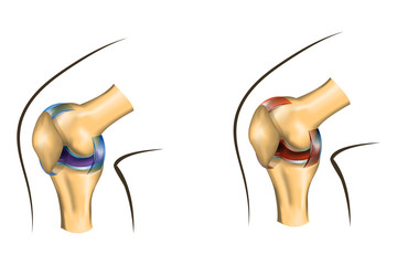 the knee joint of healthy and damaged