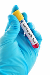Obraz premium Blood sample for lipid profile test