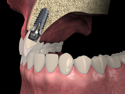 Dental anatomy - Upper incisor longitudinal section with dental implant