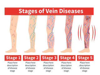 Vector Varicose infographic. Stage of vein diseases. Medical infographic.