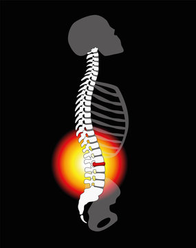 Back pain - spinal disc herniation or prolapse at a human vertebral column - profile view. Vector illustration on black background.