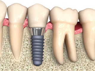 Dental anatomy - Dental implant with bone structure, teeth and gum section © lightmachine