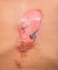Fototapeta premium close up skin of a child from wounds caused by scalding hot water.(Horrible burns)