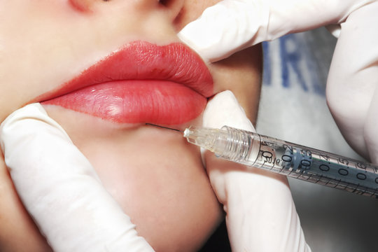 Beauty procedure - Dermatologist performs rejuvenate treatment contour plastic lips with injection of cosmetic filler on beautiful woman with red lips - find more in my portfolio