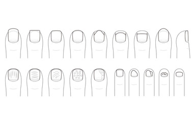 足の爪の切り方とトラブル