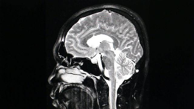 MRI brain scan on black background
