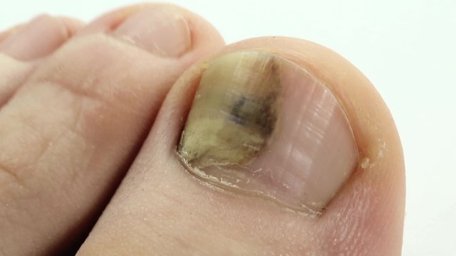 Toenails with fungal infection. Sick nail. Fungus of big toe. Trauma of toenail. Fungi Toes. Bruise under the nail of big toe. Injury to nail. Subungual hematoma. Separation of the nail from nail bed