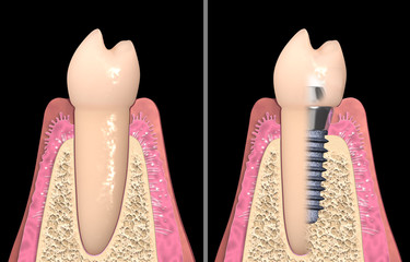 Dental anatomy - Dental implant with bone structure, teeth and gum section © lightmachine
