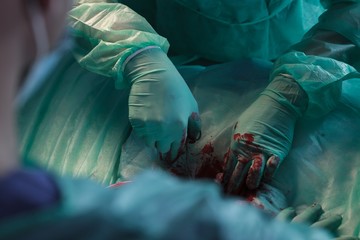 Surgeon's hands removing ailing tissue