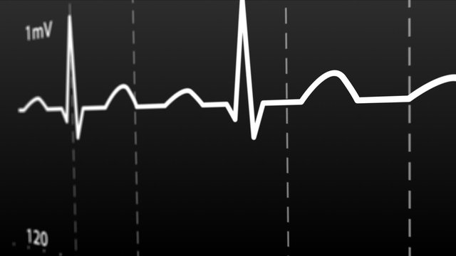 Animation of Intensive Care Unit monitor showing normal values for vital signs.