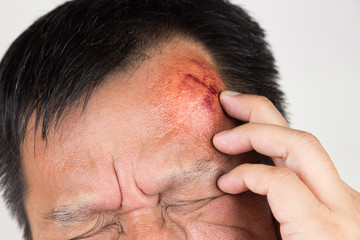 Fototapeta premium Selective focus on painful red swollen forehead injury