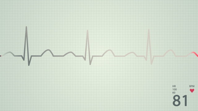 Animation of a schematic diagram of normal sinus rhythm for a human heart