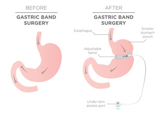Gastric Band for Weight Loss.  If you Tighten or Loosen it, It Lets More Food Slide Down in the Lower Stomach.  The Doctor Assistant Adjusts the Tightness of the Band with a Port that's Under the Skin
