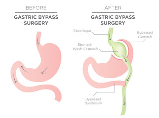 Gastric Bypass for Weight Loss - You Are Actually Re-routing Your Stomach in Order to Feel Full and Eat Less - obrazy, fototapety, plakaty