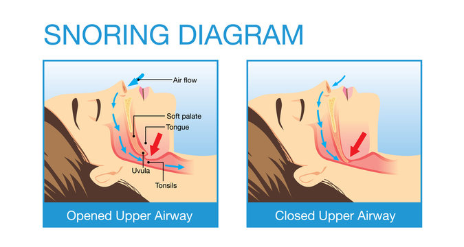 Anatomy of woman while normal sleeping and have snoring. Illustration about health care and medical