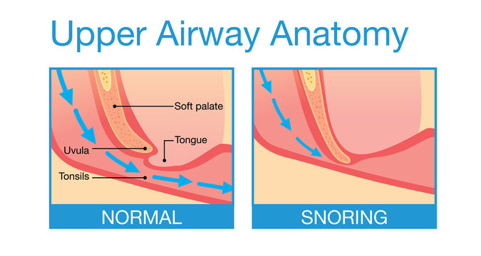 Upper Airway Human Anatomy In Normal Sleeping And Have Snoring.