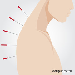 Getting acupuncture treatment. - 98759808
