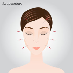 Woman getting an acupuncture treatment - 98759819