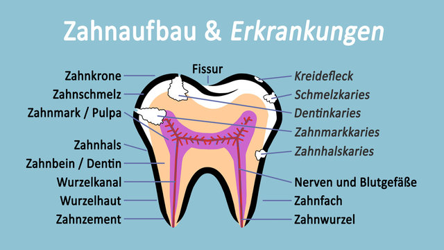ts2 ToothSign - Abbildung türkis - Backenzahn im Schnitt - Aufbau und Erkrankungen - 16zu9 g4108