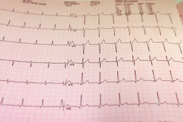 Électrocardiogramme