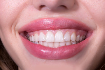 Dental female smile