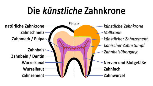 ts12 ToothSign - Abbildung weiss - Backenzahn im Schnitt - Die künstliche Zahnkrone - 16zu9 g4119