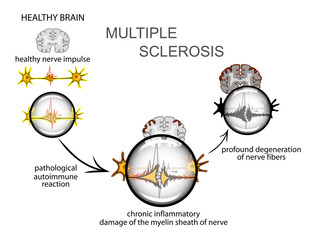 multiple sclerosis. Neurology