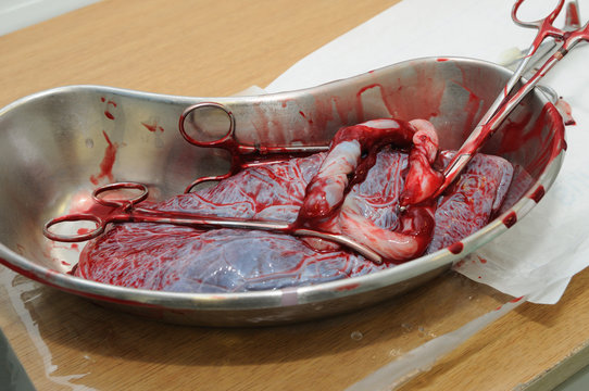  Placenta After Giving Birth