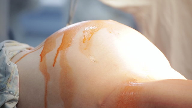 Caesarean section preeataion,surgeon putting iodine on woman stomach