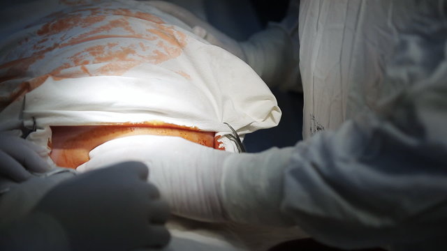 Caesarean section, prepare to cut stomach with scalpel