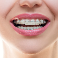 Teeth with Braces, Dental Care concept, front view. Smile with Sapphire braces. The Gap between the Teeth. Orthodontic treatment..