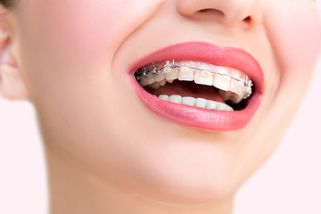 Close up Ceramic and Metal Braces on Teeth. Beautiful Female Smile with Self-ligating Braces. Orthodontic Treatment. .