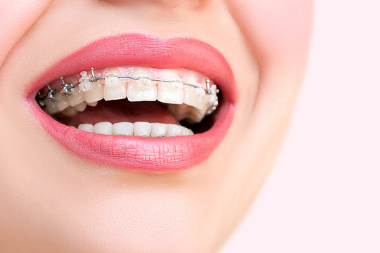 Close up open mouth with Ceramic and Metal Braces on beautiful Teeth. Broad Smile with Self-ligating Brackets. Orthodontic Treatment. Woman Smiling Showing Dental Braces..