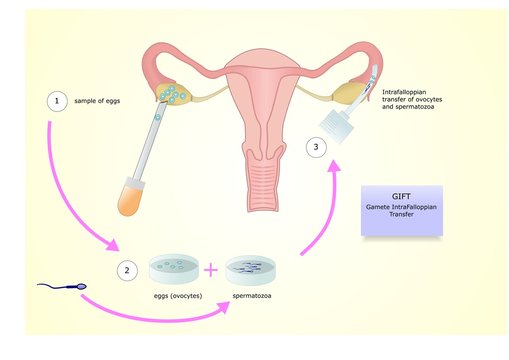 Gift, Gamete IntraFalloppian Transfer, una tecnica di inseminazione artificiale, o fecondazione assistita per trattare l'infertilità