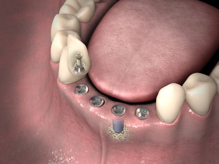 Dental anatomy - Lower incisors with bone structure, teeth, gum section and dental implant © lightmachine