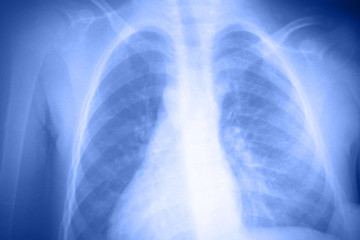 Doctor check a lung x-ray