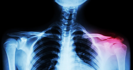 Film x-ray both clavicle AP ( front view ) : show fracture distal left clavicle - obrazy, fototapety, plakaty