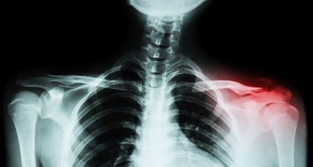 Film x-ray both clavicle AP ( front view ) : show fracture distal left clavicle - obrazy, fototapety, plakaty