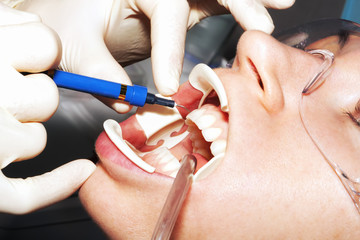 Dental hygiene and medical procedures in the dental office with teeth whitening  and cleaning treatment