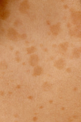 Medical: Tinea versicolor is a condition caused by the Malassezia globosa fungus a form of yeasts. It is characterized by a skin discolor eruption on the trunk and proximal extremities.