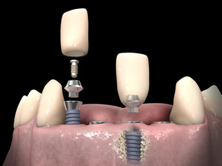 Dental anatomy - Lower incisors with bone structure, teeth, gum section and dental implant © lightmachine