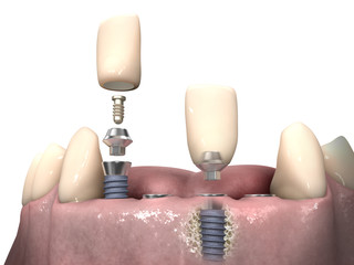 Dental anatomy - Lower incisors with bone structure, teeth, gum section and dental implant
