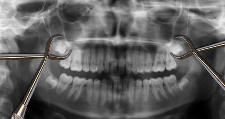 orthodontic tools and wisdom teeth