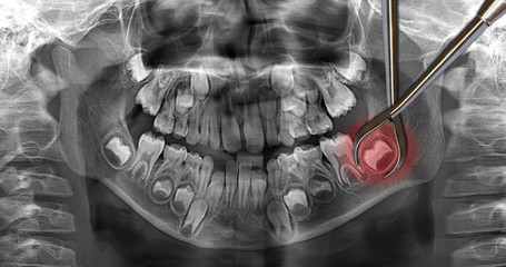 dental scan: wisdom teeth