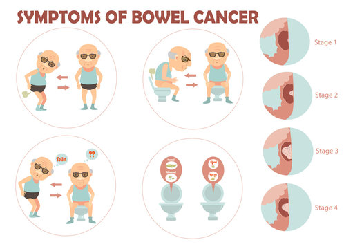 bowel cancer Old man suffered colon cancer and charts the growth of tumors in the colon infographic.Vector illustration