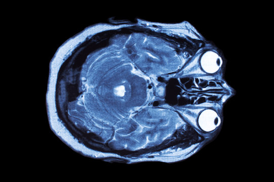 X-ray image of the brain computed tomography